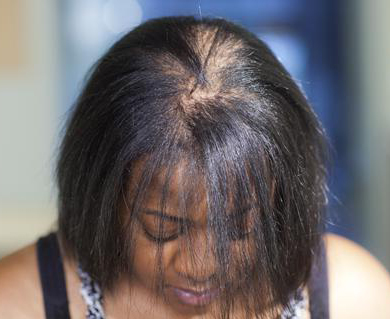 minoxidil regrow hairline